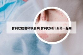 甘利欣膠囊和銀屑病 甘利欣和什么藥一起用