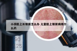 小孩臉上長(zhǎng)銀屑怎么辦 兒童臉上銀屑病用什么藥