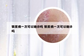 銀屑病一次可以確診嗎 銀屑病一次可以確診嗎
