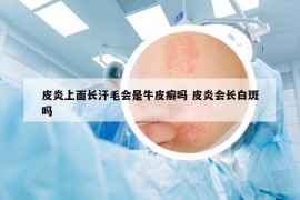 皮炎上面長汗毛會是牛皮癬嗎 皮炎會長白斑嗎
