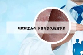 銀皮屑怎么辦 銀皮屑多久能消下去
