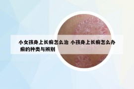 小女孩身上長癬怎么治 小孩身上長癬怎么辦 癬的種類與辨別
