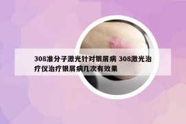 308準分子激光針對銀屑病 308激光治療儀治療銀屑病幾次有效果