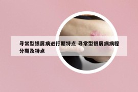 尋常型銀屑病進(jìn)行期特點(diǎn) 尋常型銀屑病病程分期及特點(diǎn)