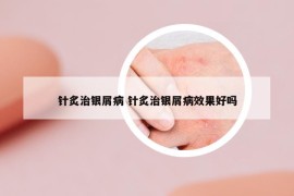 針炙治銀屑病 針炙治銀屑病效果好嗎
