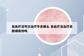 自血療法可以治療牛皮癬么 自血療法治療皮膚病有效嗎