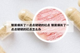 銀屑病長了一點點硬硬的紅點 銀屑病長了一點點硬硬的紅點怎么辦