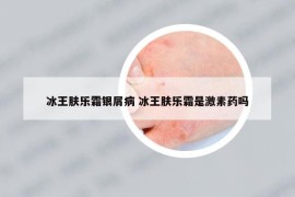 冰王膚樂霜銀屑病 冰王膚樂霜是激素藥嗎