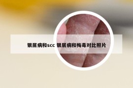銀屑病和scc 銀屑病和梅毒對(duì)比照片