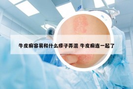 牛皮癬容易和什么疹子弄混 牛皮癬連一起了