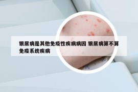 銀屑病是其他免疫性疾病病因 銀屑病算不算免疫系統(tǒng)疾病