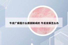 牛皮廣癬是什么原因制成的 牛皮皮癬怎么辦