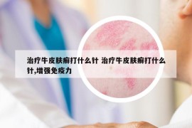 治療牛皮膚癬打什么針 治療牛皮膚癬打什么針,增強(qiáng)免疫力