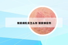 銀屑病乳膏怎么樣 銀屑病膏劑