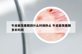 牛皮癬發(fā)展期到什么時候停止 牛皮癬發(fā)展期多長時間