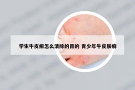 學(xué)生牛皮癬怎么清除的目的 青少年牛皮膚癬