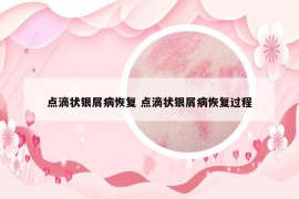 點(diǎn)滴狀銀屑病恢復(fù) 點(diǎn)滴狀銀屑病恢復(fù)過程