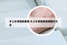 手上長(zhǎng)掌跖膿皰病 手上長(zhǎng)掌跖膿皰病圖片大全