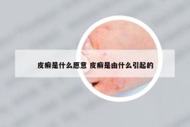 皮癬是什么愿意 皮癬是由什么引起的
