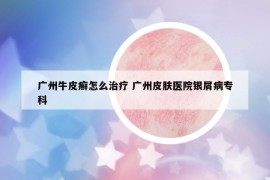 廣州牛皮癬怎么治療 廣州皮膚醫(yī)院銀屑病?？? /></a>		
		</figure>

		<header class=