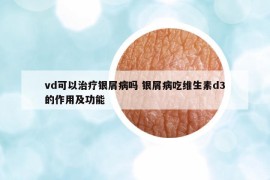 vd可以治療銀屑病嗎 銀屑病吃維生素d3的作用及功能