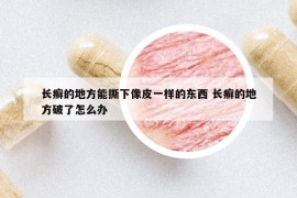 長癬的地方能撕下像皮一樣的東西 長癬的地方破了怎么辦