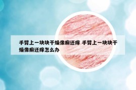 手臂上一塊塊干燥像癬還癢 手臂上一塊塊干燥像癬還癢怎么辦