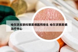 哈爾濱皮膚科銀屑病醫(yī)院排名 哈爾濱銀屑病治療中心