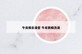 牛皮癬去澡堂 牛皮膚癬洗澡
