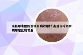 南昌哪家醫(yī)院治銀屑病效果好 南昌治療銀屑病哪家比較專業(yè)
