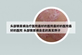 頭部銀屑病治療醫(yī)院最好的醫(yī)院最好的醫(yī)院最好的醫(yī)院 頭部銀屑病自愈的真實(shí)例子