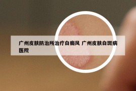 廣州皮膚防治所治療白癜風(fēng) 廣州皮膚白斑病醫(yī)院