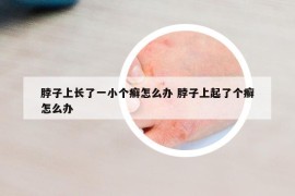 脖子上長(zhǎng)了一小個(gè)癬怎么辦 脖子上起了個(gè)癬怎么辦
