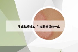 牛皮膚癬戒口 牛皮膚癬禁吃什么