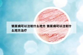 銀屑病可以注射什么地方 銀屑病可以注射什么地方治療