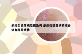 皰疹型銀屑病能根治嗎 皰疹性銀屑病初期身體有哪些癥狀