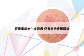 蝦青素能治牛皮蘚嗎 蝦青素治療銀屑病