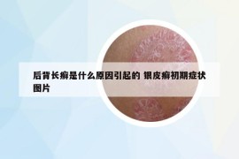 后背長(zhǎng)癬是什么原因引起的 銀皮癬初期癥狀圖片
