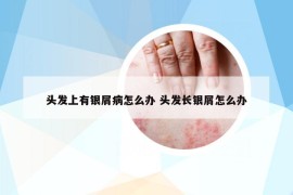 頭發(fā)上有銀屑病怎么辦 頭發(fā)長銀屑怎么辦