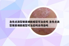 急性點滴型銀屑病膿皰型可治愈嗎 急性點滴型銀屑病膿皰型可治愈嗎會傳染嗎