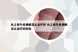 頭上有牛皮病癬怎么治療好 頭上有牛皮病癬怎么治療好的快