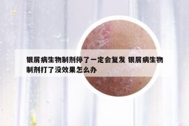 銀屑病生物制劑停了一定會復發(fā) 銀屑病生物制劑打了沒效果怎么辦