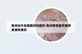 泰州治牛皮癬最好的醫(yī)院 泰州哪家醫(yī)院看銀屑病效果好