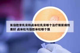 氯倍他索乳膏和鹵米松乳膏哪個(gè)治療銀屑病效果好 鹵米松與倍他米松哪個(gè)強(qiáng)