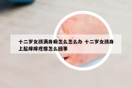 十二歲女孩滿身癬怎么怎么辦 十二歲女孩身上起癢癢疙瘩怎么回事