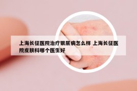 上海長征醫(yī)院治療銀屑病怎么樣 上海長征醫(yī)院皮膚科哪個醫(yī)生好