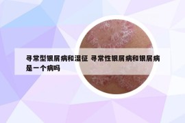 尋常型銀屑病和濕征 尋常性銀屑病和銀屑病是一個病嗎