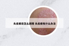頭皮癬該怎么調(diào)理 頭皮癬有什么辦法