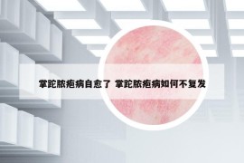 掌跎膿皰病自愈了 掌跎膿皰病如何不復(fù)發(fā)