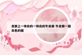 皮膚上一塊白的一塊白的牛皮癬 牛皮癬一圈白色的圈